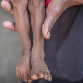 A mother holds the legs of her 13-month-old child who is severely malnourished. The baby was treated for malnutrition in a Save the Children supported clinic. After his treatment ended, he and his family got displaced as conflict in their neighborhood escalated and it wasn’t safe to live there anymore. Photo credit: Mohammed Awadh / Save the Children, Oct 2018. A mother holds the legs of her 13-month-old child who is severely malnourished. The baby was treated for malnutrition in a Save the Children supported clinic. After his treatment ended, he and his family got displaced as conflict in their neighborhood escalated and it wasn’t safe to live there anymore. Photo credit: Mohammed Awadh / Save the Children, Oct 2018.