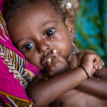 An 11-month old baby girl suffering from severe acute malnutrition eats a nutritious peanut paste given by a Save the Children health worker in a camp for Internally Displaced People (IDP) in Lahj district, Yemen. Photo credit: Jonathan Hyams / Save the Children, Nov 2018. An 11-month old baby girl suffering from severe acute malnutrition eats a nutritious peanut paste given by a Save the Children health worker in a camp for Internally Displaced People (IDP) in Lahj district, Yemen. Photo credit: Jonathan Hyams / Save the Children, Nov 2018.